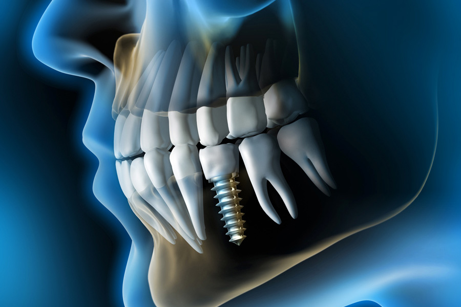implantologia 3D guidata